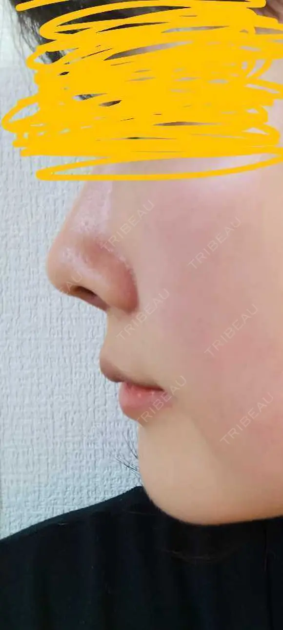 軟骨移植 LIKI CLINIC KOBE DAY 7 メイン用