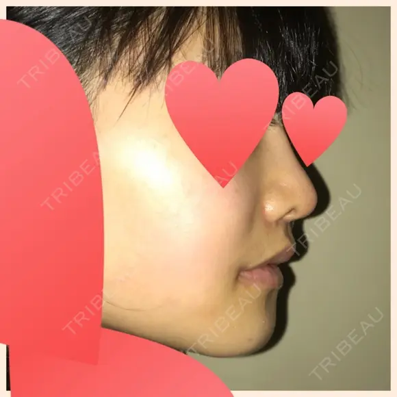 セットバック 大塚美容形成外科・歯科 大塚本院 DAY 40 メイン用