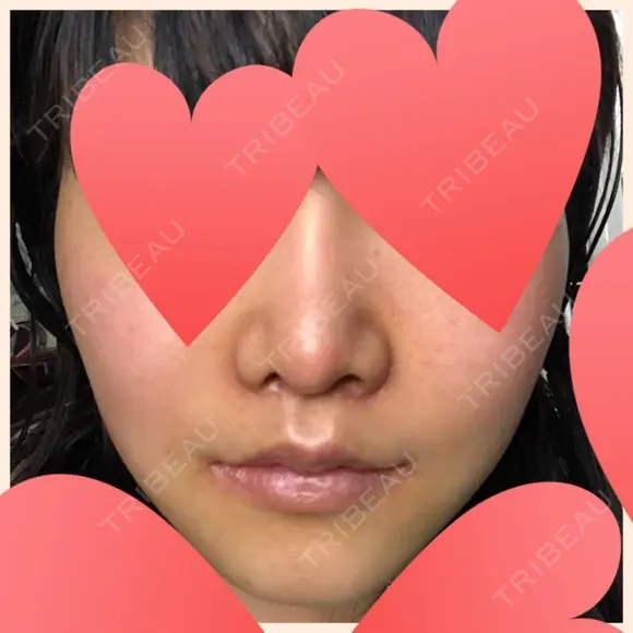 セットバック 大塚美容形成外科・歯科 大塚本院 DAY 40 メイン用