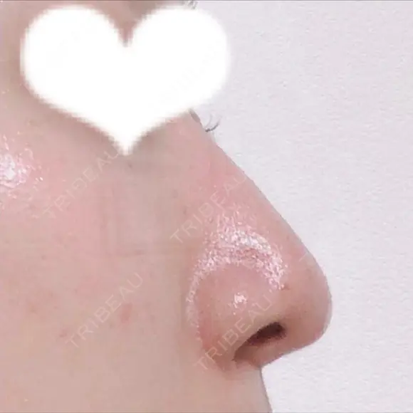 鼻尖形成（切開） / 鼻中隔延長（切開） / 小鼻縮小（切開） / 軟骨移植 / 骨切幅寄せ リラ・クラニオフェイシャル・クリニック DAY 306 メイン用