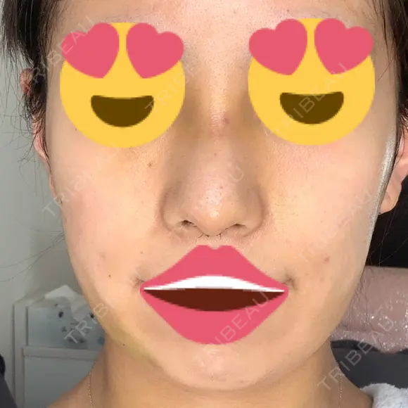 隆鼻術 / 鼻尖形成（切開） / 脂肪吸引（顔） / 軟骨移植 あいちビューティークリニック栄本院 DAY 5 メイン用