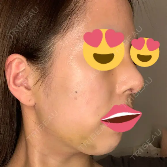 隆鼻術 / 鼻尖形成（切開） / 脂肪吸引（顔） / 軟骨移植 あいちビューティークリニック栄本院 DAY 6 メイン用