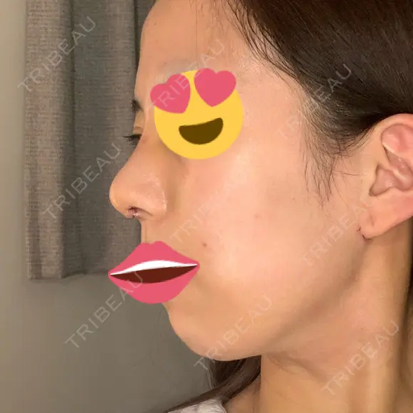 隆鼻術 / 鼻尖形成（切開） / 脂肪吸引（顔） / 軟骨移植 あいちビューティークリニック栄本院 DAY 6 メイン用