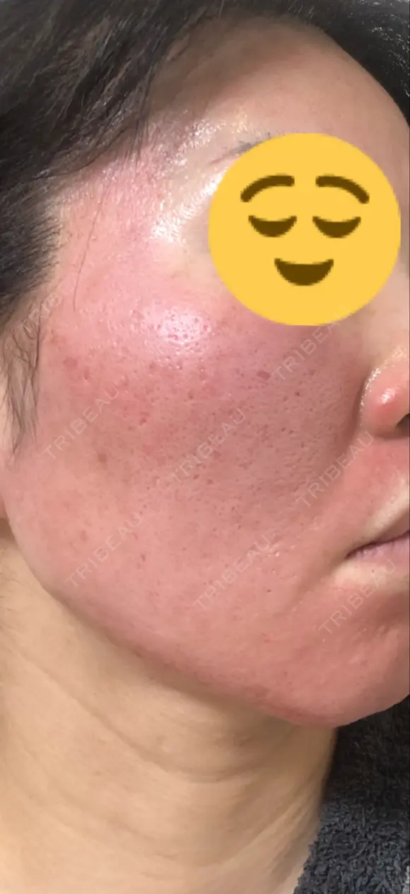 ヴァンパイアフェイシャル 大阪TAクリニック DAY 1 メイン用