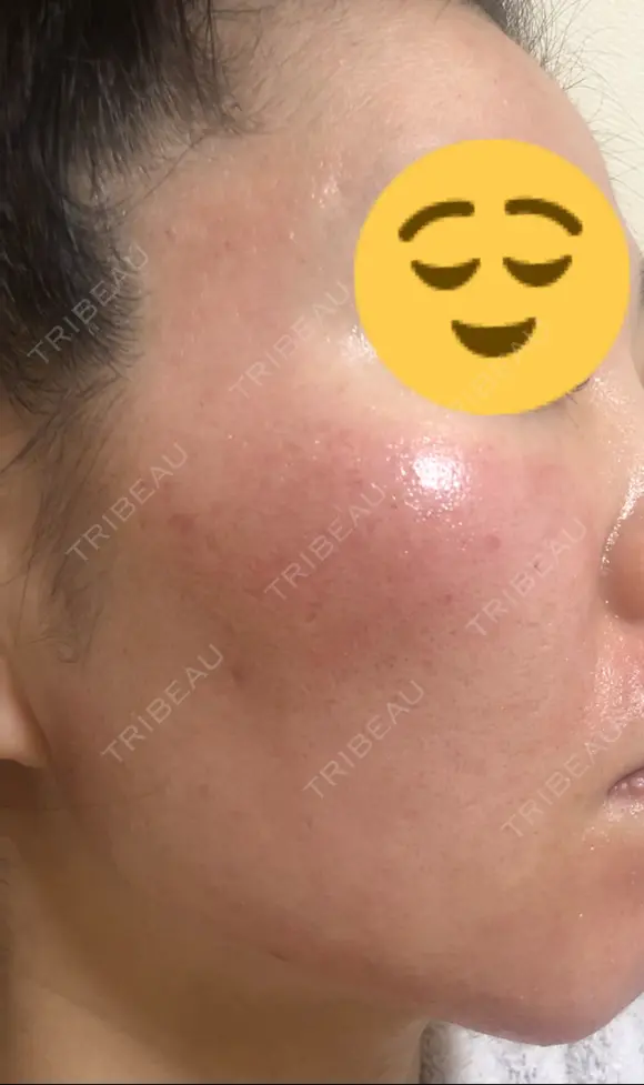 ヴァンパイアフェイシャル 大阪TAクリニック DAY 2 メイン用