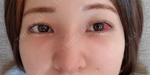 鼻尖形成（切開） / 鼻中隔延長（切開） / クマ治療 / 軟骨移植 R Beauty CLINIC 銀座院 DAY 16 メイン用