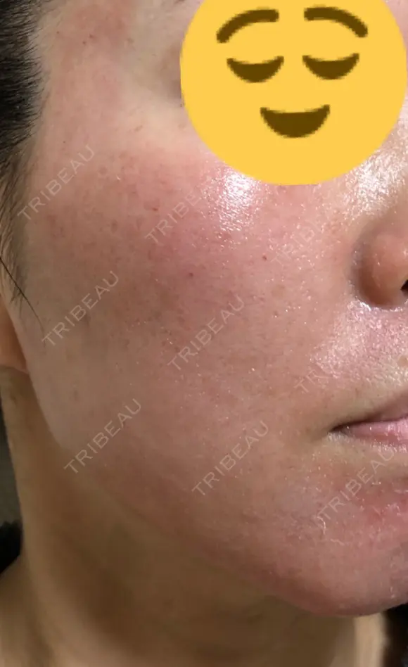 ヴァンパイアフェイシャル 大阪TAクリニック DAY 2 メイン用