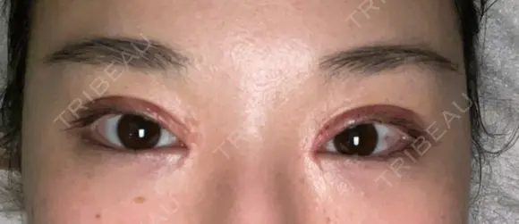 二重切開 / 目頭切開 / 眼瞼下垂（切開） 目白ポセンシアクリニック DAY 10 メイン用