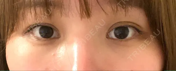 クマ治療 / 下まぶたたるみ取り / 下まぶたの脂肪取り APOLLO BEAUTY CLINIC AFTER メイン用