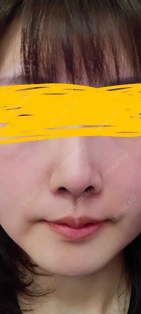 軟骨移植 LIKI CLINIC KOBE DAY 10 メイン用