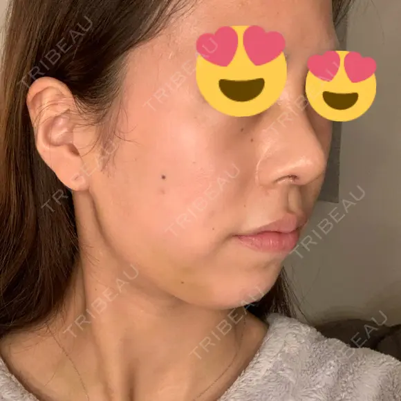 隆鼻術 / 鼻尖形成（切開） / 脂肪吸引（顔） / 軟骨移植 あいちビューティークリニック栄本院 DAY 9 メイン用