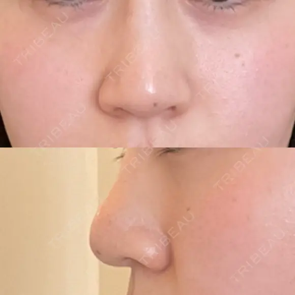 鼻尖形成（切開） / 鼻尖縮小 / その他（鼻） 聖心美容クリニック 札幌院 DAY 179 メイン用