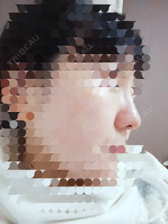 鼻尖形成（切開） / 鼻尖縮小 / ヒアルロン酸注入（鼻） 東京形成美容外科 船橋院 DAY 38 メイン用