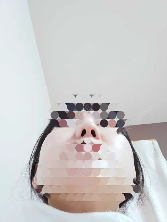 鼻尖形成（切開） / 鼻尖縮小 / ヒアルロン酸注入（鼻） 東京形成美容外科 船橋院 DAY 38 メイン用