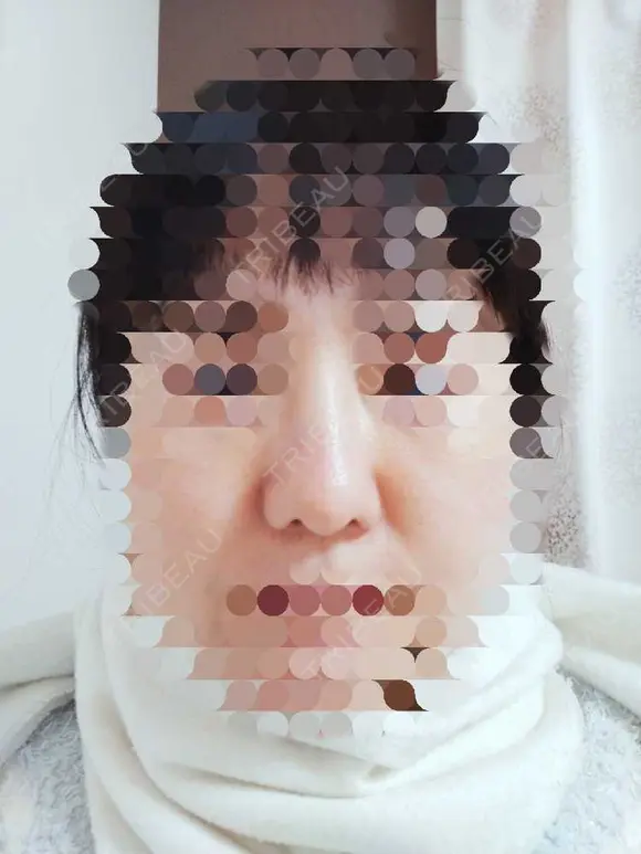 鼻尖形成（切開） / 鼻尖縮小 / ヒアルロン酸注入（鼻） 東京形成美容外科 船橋院 DAY 38 メイン用