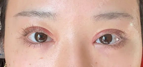 二重切開 / 目頭切開 / 眼瞼下垂（切開） 目白ポセンシアクリニック DAY 12 メイン用