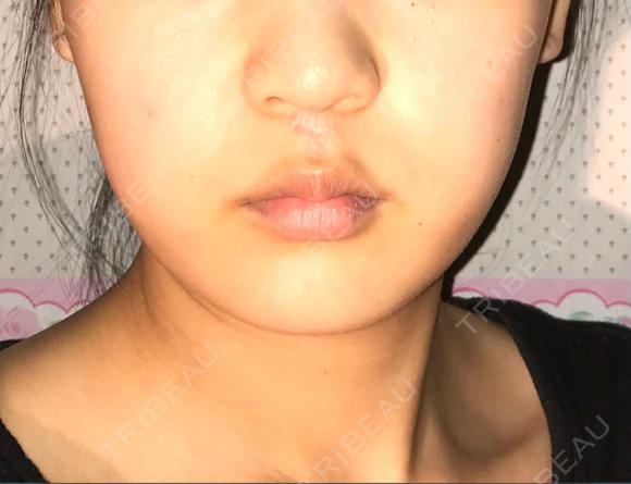 脂肪溶解注射（顔） 有楽町美容外科クリニック AFTER メイン用