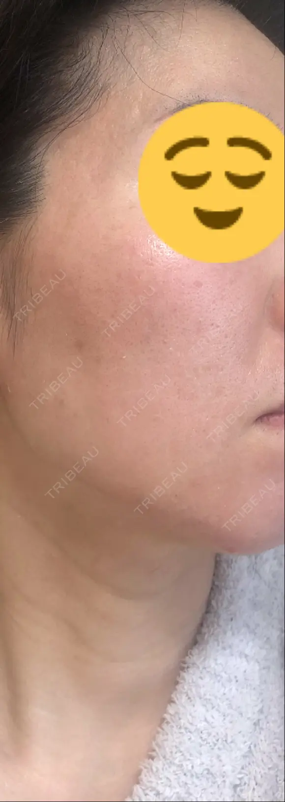 ヴァンパイアフェイシャル 大阪TAクリニック DAY 5 メイン用