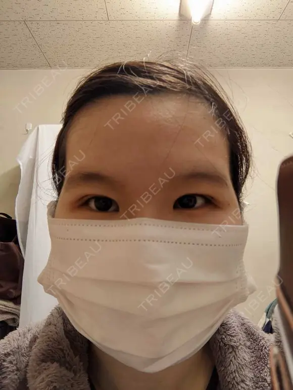 二重埋没 / 上まぶたの脂肪取り 東京イセアクリニック DAY 8 メイン用
