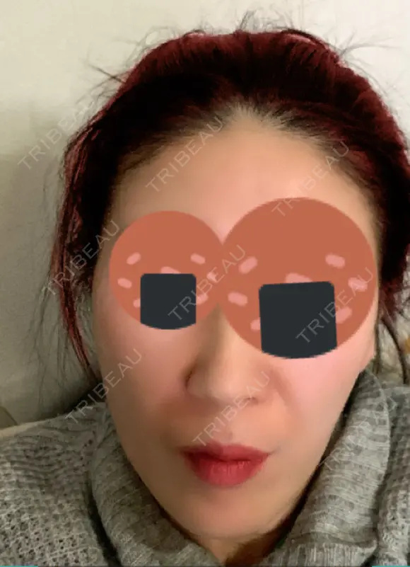 再生医療 クリニックビューティー恵比寿 DAY 16 メイン用