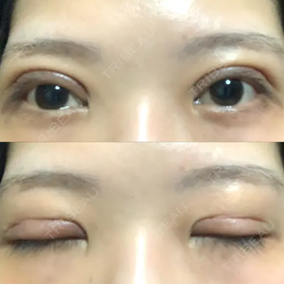 二重切開 / その他（目元） LIKI CLINIC KOBE DAY 7 メイン用