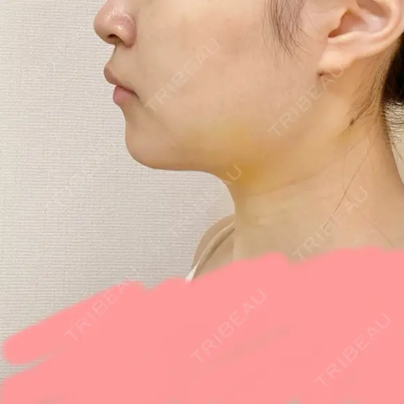 バッカルファット除去 / 脂肪吸引（顔） 湘南美容クリニック 新潟院 DAY 5 メイン用