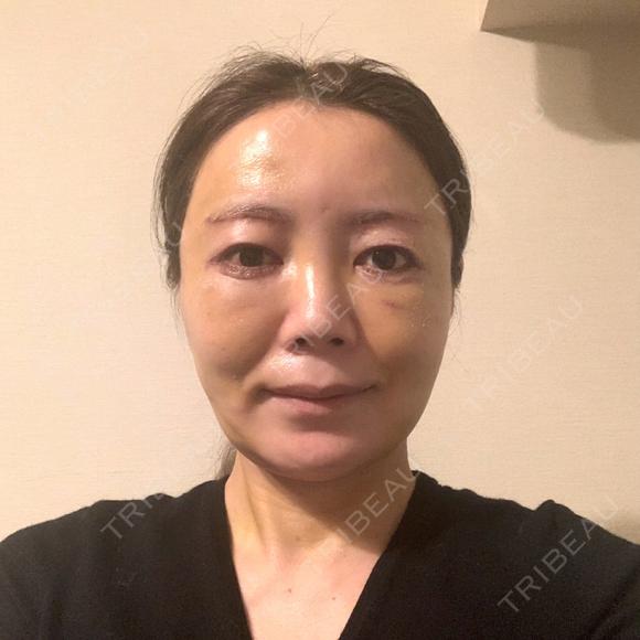 糸リフト / 脂肪吸引（顔） / 下まぶたたるみ取り / 眉下切開 / 脂肪注入（額） / 脂肪注入（輪郭） e:Top clinic（イートップクリニック） DAY 7 メイン用