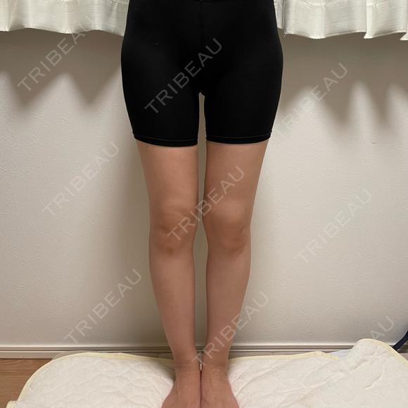 脂肪吸引（脚） オアシス美容外科 DAY 55 メイン用