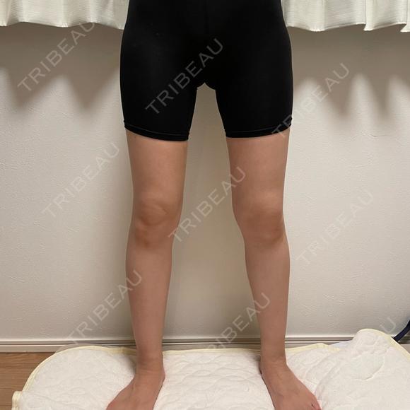脂肪吸引（脚） オアシス美容外科 DAY 55 メイン用
