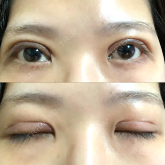 二重切開 / その他（目元） LIKI CLINIC KOBE DAY 10 メイン用