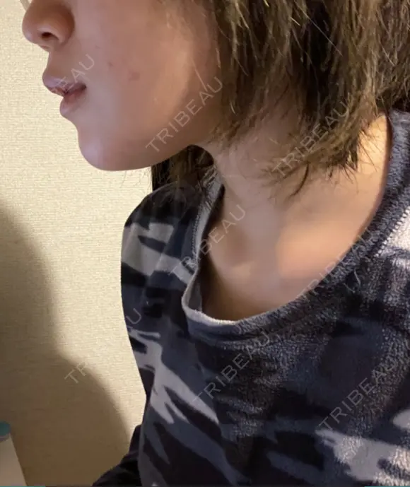 骨切り（あご） 銀座マイアミ美容外科 DAY 34 メイン用