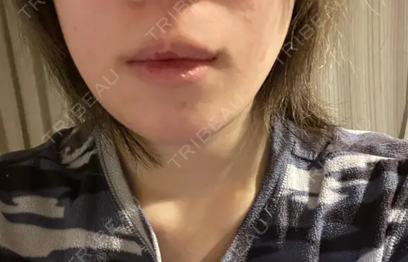 骨切り（あご） 銀座マイアミ美容外科 DAY 34 メイン用