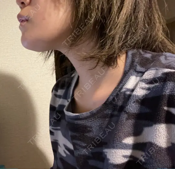 骨切り（あご） 銀座マイアミ美容外科 DAY 34 メイン用