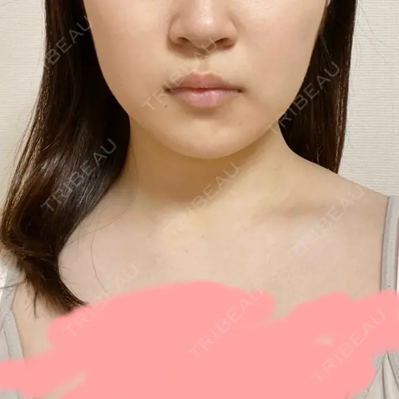 バッカルファット除去 / 脂肪吸引（顔） 湘南美容クリニック 新潟院 DAY 8 メイン用