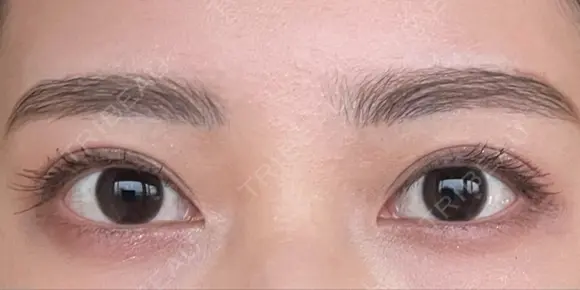 二重切開 ルネッサンス美容外科医院 神戸院 AFTER メイン用