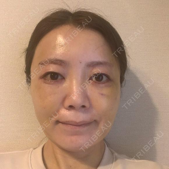 糸リフト / 脂肪吸引（顔） / 下まぶたたるみ取り / 眉下切開 / 脂肪注入（額） / 脂肪注入（輪郭） e:Top clinic（イートップクリニック） DAY 9 メイン用