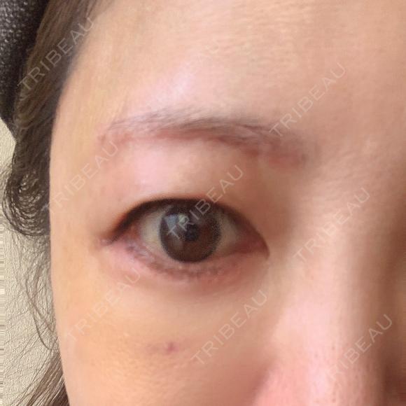 糸リフト / 脂肪吸引（顔） / 下まぶたたるみ取り / 眉下切開 / 脂肪注入（額） / 脂肪注入（輪郭） e:Top clinic（イートップクリニック） DAY 10 メイン用