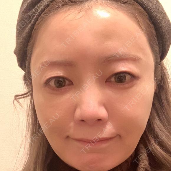 糸リフト / 脂肪吸引（顔） / 下まぶたたるみ取り / 眉下切開 / 脂肪注入（額） / 脂肪注入（輪郭） e:Top clinic（イートップクリニック） DAY 10 メイン用