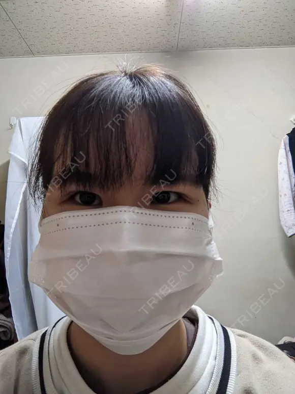 二重埋没 / 上まぶたの脂肪取り 東京イセアクリニック DAY 13 メイン用