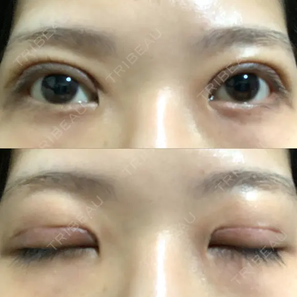 二重切開 / その他（目元） LIKI CLINIC KOBE DAY 12 メイン用