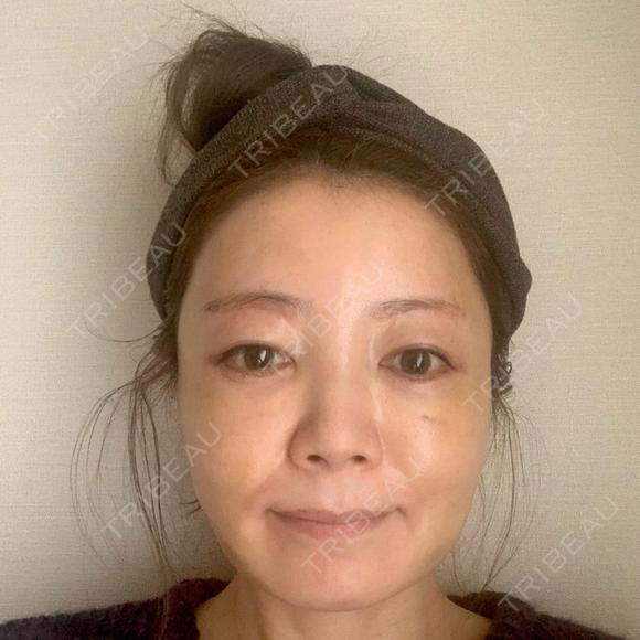 糸リフト / 脂肪吸引（顔） / 下まぶたたるみ取り / 眉下切開 / 脂肪注入（額） / 脂肪注入（輪郭） e:Top clinic（イートップクリニック） DAY 11 メイン用