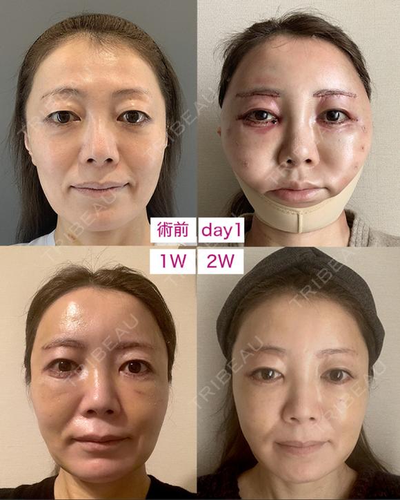 糸リフト / 脂肪吸引（顔） / 下まぶたたるみ取り / 眉下切開 / 脂肪注入（額） / 脂肪注入（輪郭） e:Top clinic（イートップクリニック） AFTER メイン用