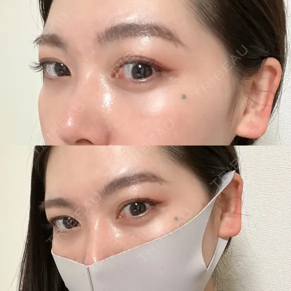 アートメイク（ほくろ） oneUPclinic DAY 28 メイン用