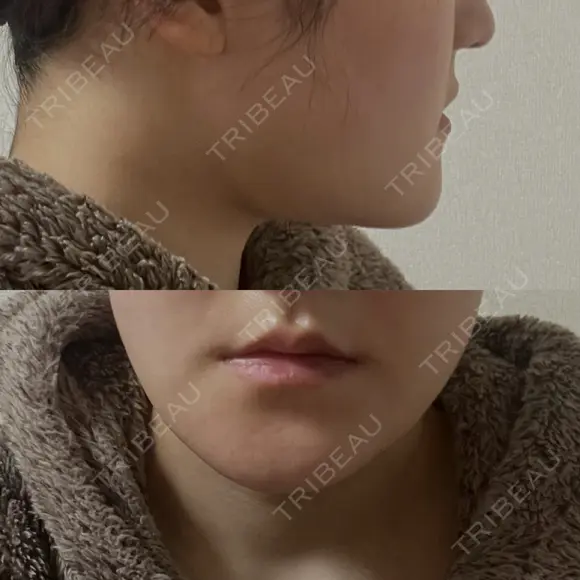 骨切り（あご） / 脂肪吸引（顔） / その他（輪郭） 銀座マイアミ美容外科 DAY 21 メイン用