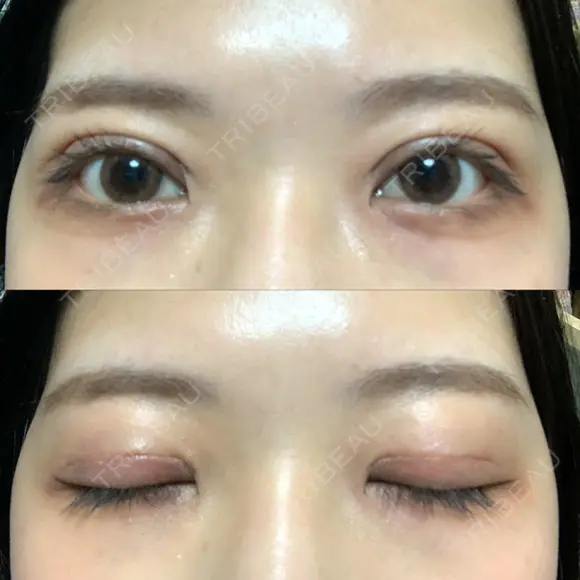 二重切開 / その他（目元） LIKI CLINIC KOBE DAY 14 メイン用