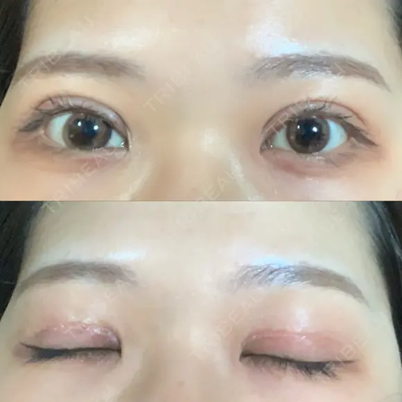 二重切開 / その他（目元） LIKI CLINIC KOBE DAY 14 メイン用