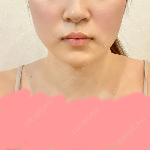 バッカルファット除去 / 脂肪吸引（顔） 湘南美容クリニック 新潟院 DAY 14 メイン用