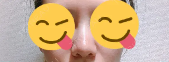 鼻尖形成（切開） / 小鼻縮小（切開） / ヒアルロン酸注入（鼻） 東京ヒルズクリニック 新宿院 AFTER メイン用