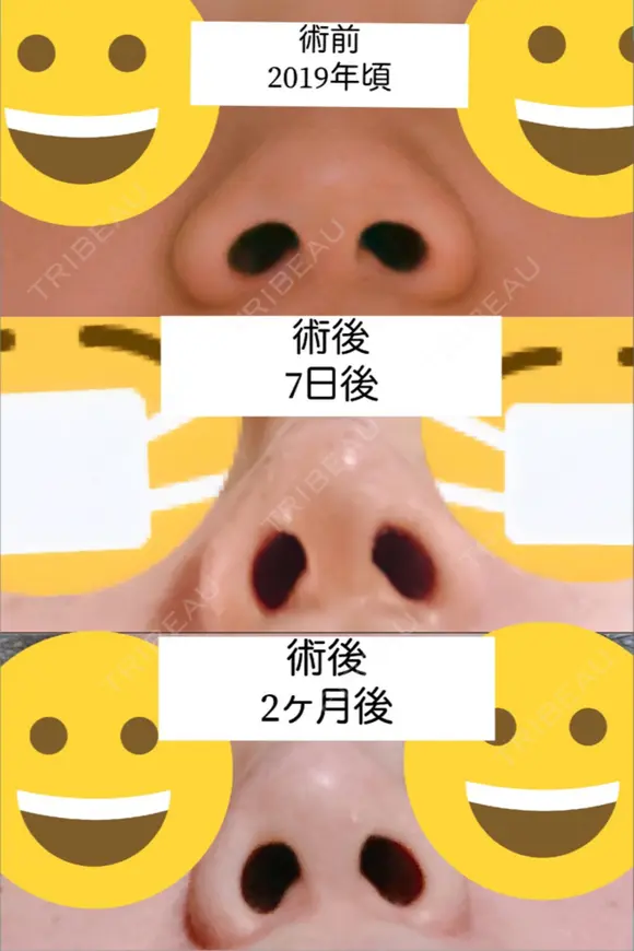 鼻尖形成（切開） / 小鼻縮小（切開） / ヒアルロン酸注入（鼻） 東京ヒルズクリニック 新宿院 DAY 63 メイン用