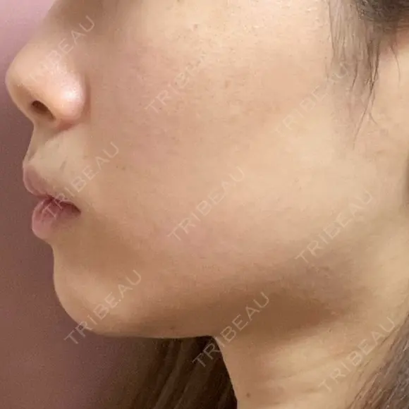 RF（高周波）たるみ治療 東京皮膚科・形成外科　品川院 DAY 6 メイン用